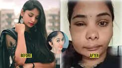 After Chethana Raj’s fatal plastic surgery, now Swathi Sathish’s root canal surgery goes wrong, Kannada actress looks unrecognisable with swollen face