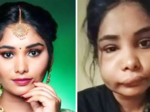 Pictures of Kannada actress Swathi Sathish go viral after her root canal surgery goes wrong