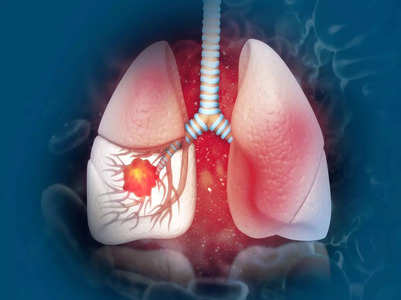 Lung cancer: Palpitations may signal tumour
