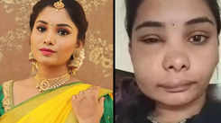 Kannada actress Swathi Sathish to sue the doctor for wrong surgery which gave her a swollen face