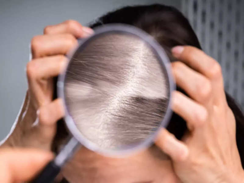 Hair fall problems? It’s time you shouldn’t ignore those