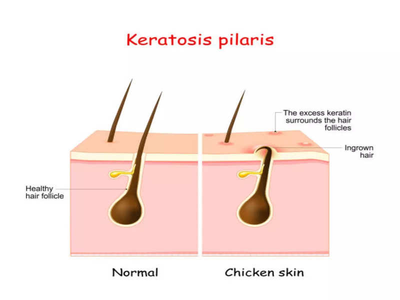 Keratosis Pilaris: This is how you can manage your ‘strawberry skin’