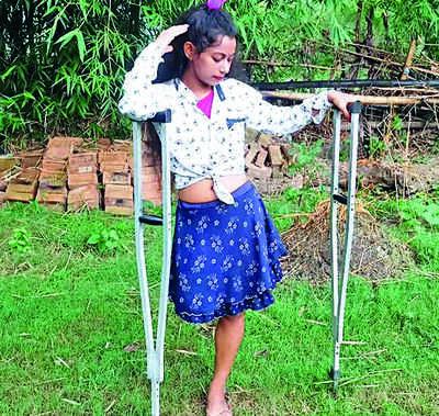 A Leg Lost In Accident, Gritty Girl Lives Her Dream As A Dancer ...