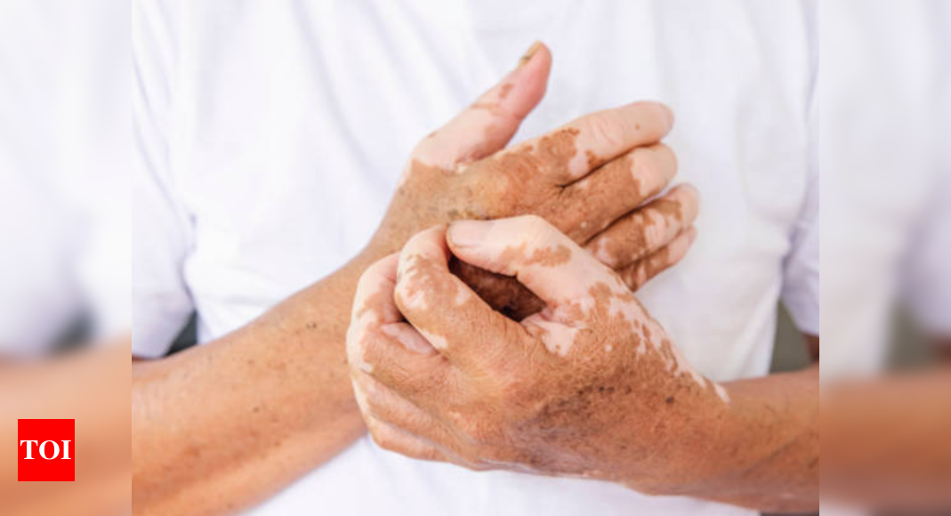 World Vitiligo Day 2022: Experts guide on how to cope up with the condition and take care of mental health – Times of India