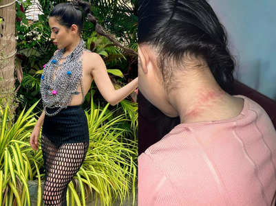 Urfi shows bruises after wearing chain top