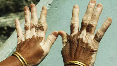 Study finds new way to reduce inflammation and prevent repigmentation in patients with vitiligo disease