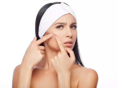 5 major causes for acne and how to treat it