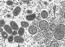 Monkeypox: Signs, symptoms and treatment