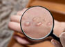 Who are more at risk of contracting monkeypox?