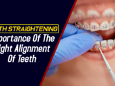 Teeth straightening: Importance of the right alignment of teeth