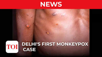 First monkeypox case reported in Delhi, patient has no foreign travel history