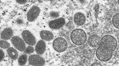 Suspected case of monkeypox found in Telangana