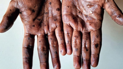 Monkeypox in Delhi, patient has no foreign travel history