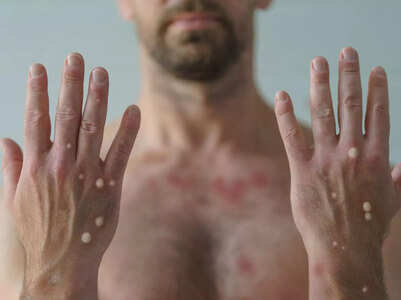 Monkeypox vs. Chickenpox: How to differentiate