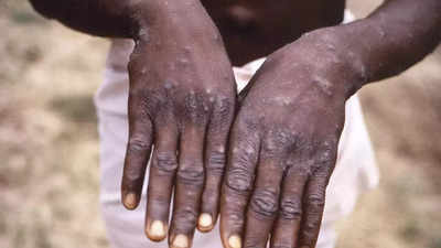 Monkeypox: Safe sexual practices and roping in dermatologists can be the key