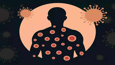 Rajasthan monkeypox scare: Balotra woman tests negative, state on alert