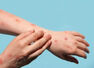 Patient shares excruciating monkeypox symptoms