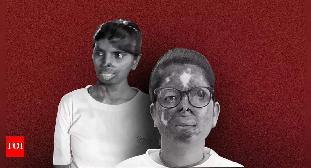 'When I first saw my face after attack, I felt like dying' | India News ...