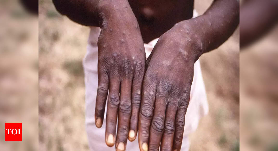 WHO: 18,000 cases of Monkeypox globally from 78 countries, mainly Europe – Times of India