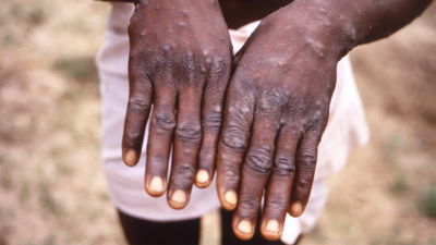 Monkeypox symptoms now different from those of earlier outbreaks: Study