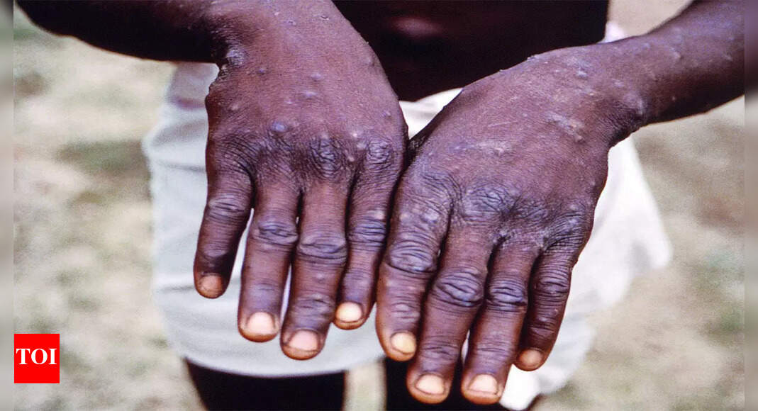 Monkeypox death in Kerala raises concern, surprises experts