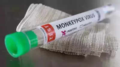 Foreign national tests positive for Monkeypox in Delhi, 8th case in country, 3rd in capital