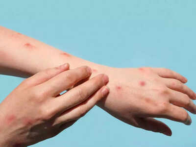 US declares public health emergency over monkeypox outbreak - Times of India