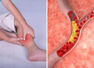 THIS colour in your leg could indicate high cholesterol