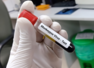 ICMR identifies A.2 monkeypox strain , know the symptoms