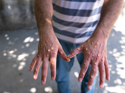 How to take care of monkeypox lesions