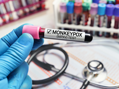 Monkeypox: 5 things doctors want you to know
