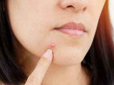 No. 1 skin cancer symptom people ignore