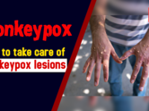 How to take care of monkeypox lesions