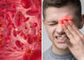 Iron deficiency: The sign inside your lower eyelid