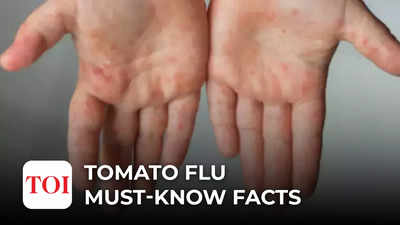 Tomato flu: What you must know about this new disease affecting children