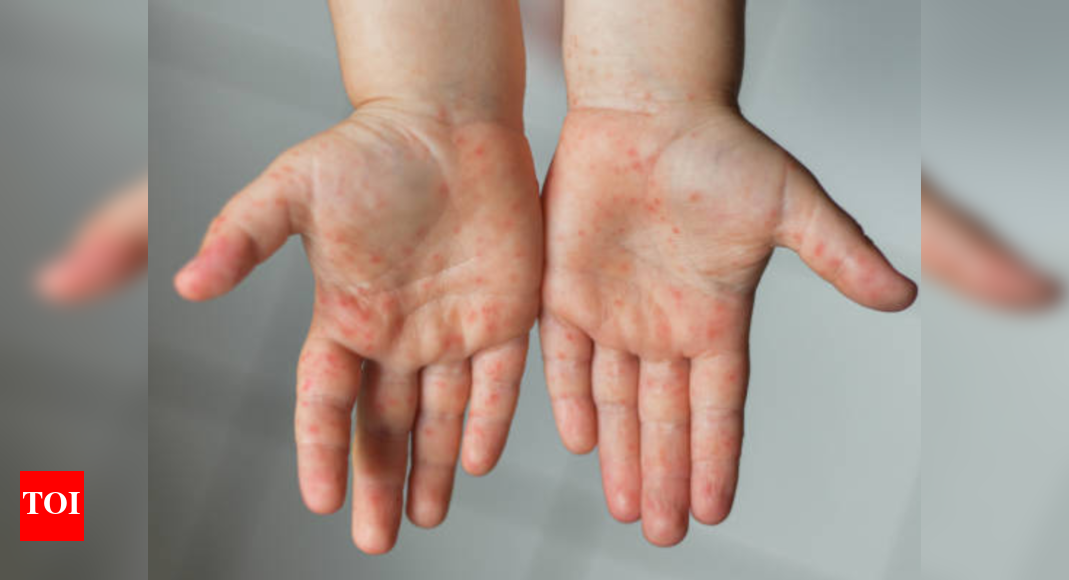 Tomato fever in kids: Symptoms that tend to confuse parents - Times of ...