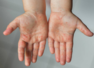 Tomato fever: Symptoms that confuse parents