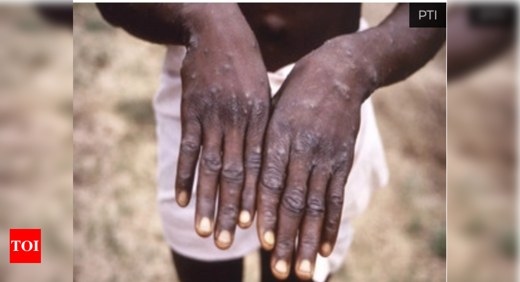 New strain of monkeypox identified in UK – Times of India