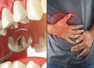 Poor oral hygiene raises risk of liver cancer