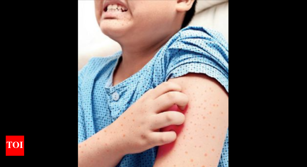 Mumbai Now, cases of handfootmouth disease seen in older children