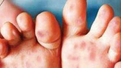 Uttarakhand govt sounds alert on hand, foot and mouth disease