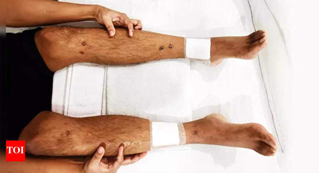 Why these Indians are paying lakhs to get bones broken India News