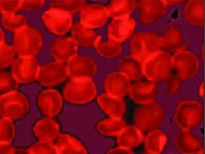 Sickle cell more prevalent among tribal females in Indore