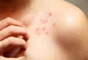 Coronavirus: Chickenpox-like rash and other less talked about troubling symptoms