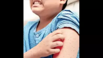 Hand-foot-mouth disease cases increasing in kids | Nagpur News - Times