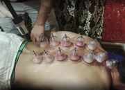 Cupping therapy, a cure for all aliments becomes trendy in kashmir