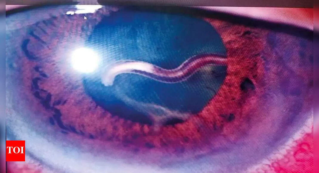 Chennai doctors remove live roundworm from monk's eye Chennai News