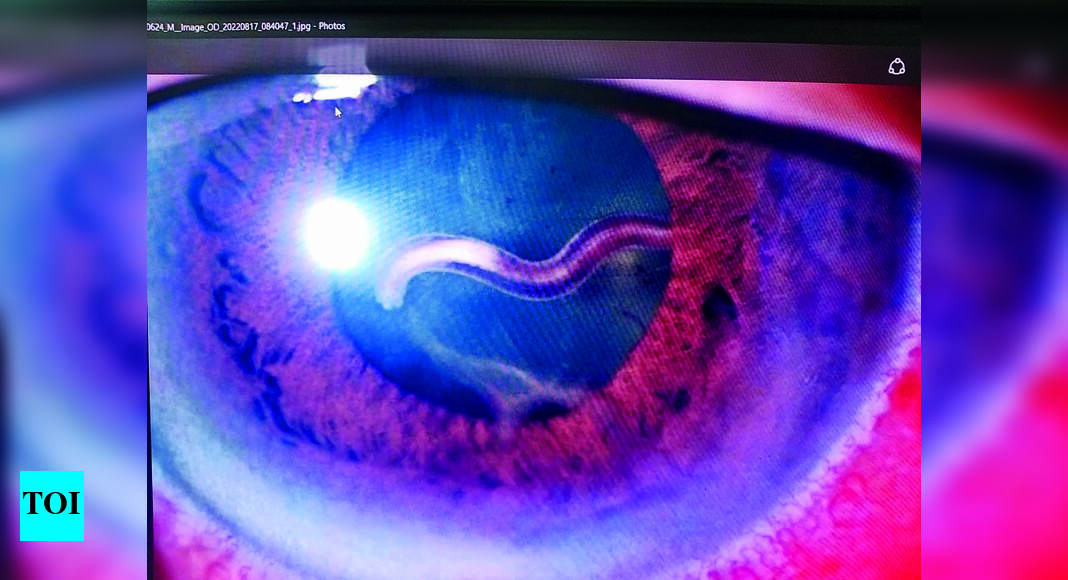 City Doctors Remove Live Roundworm From Monk’s Eye Chennai News