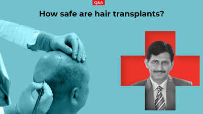 How safe are hair transplants? A doctor explains - Times of India