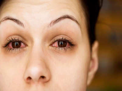5 common causes you have bloodshot eyes